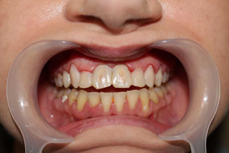 coroane din ceramica pe suport de zirconiu 3