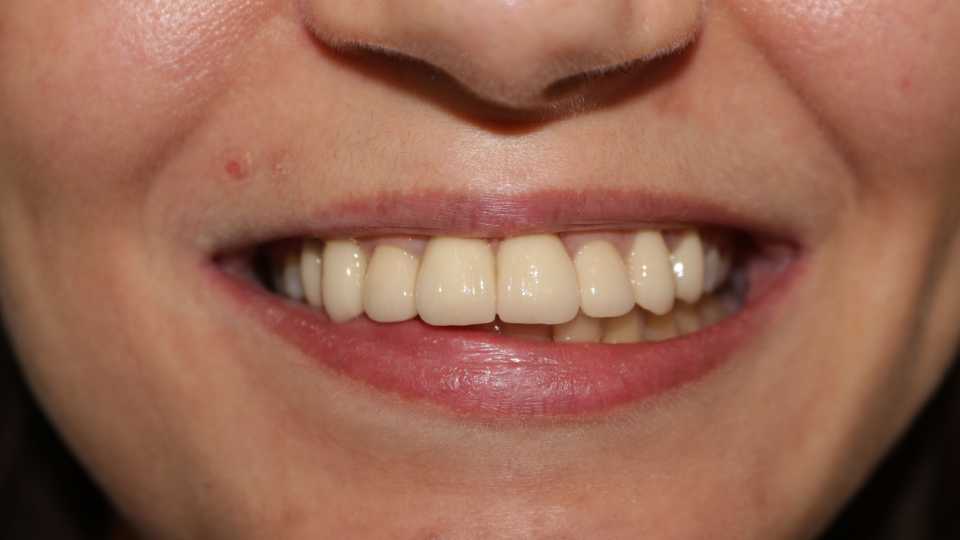 coroane din ceramica pe suport de zirconiu 4