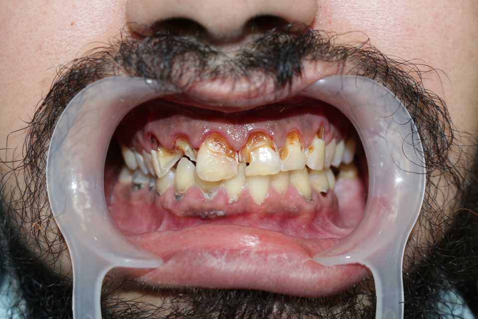 Restaurari coronare din zirconiu 1