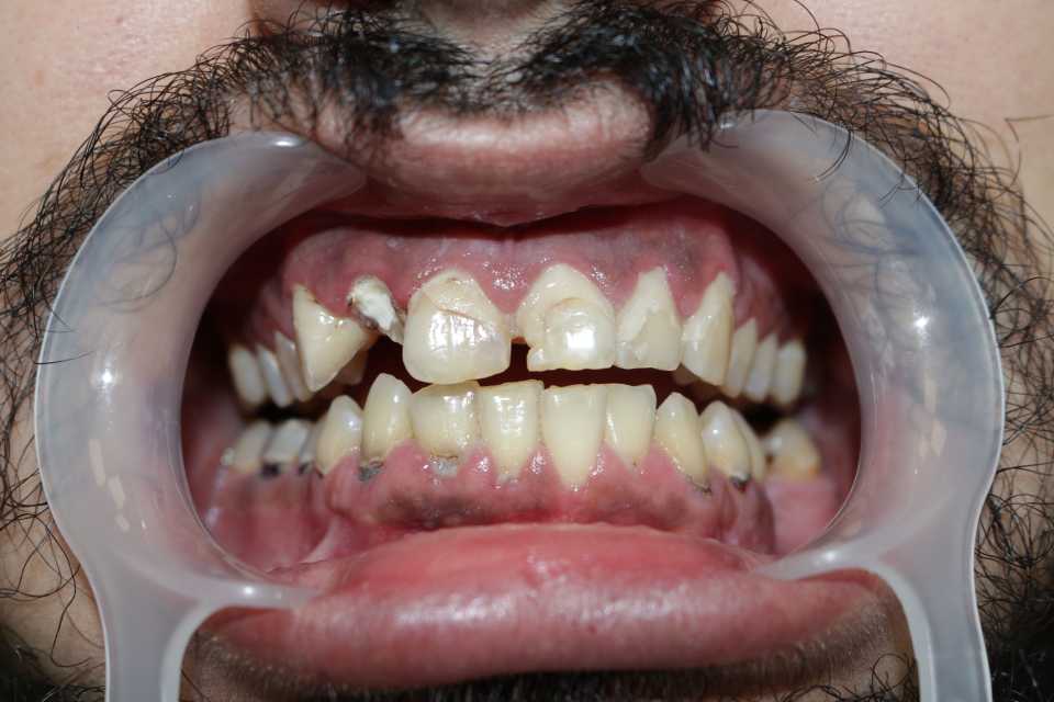 Restaurari coronare din zirconiu 2