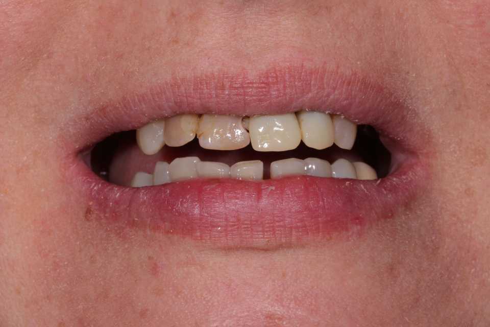 Implanturi Megagen și coroane metalo-ceramice 1