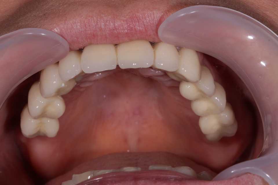 Implanturi Megagen și coroane metalo-ceramice 2