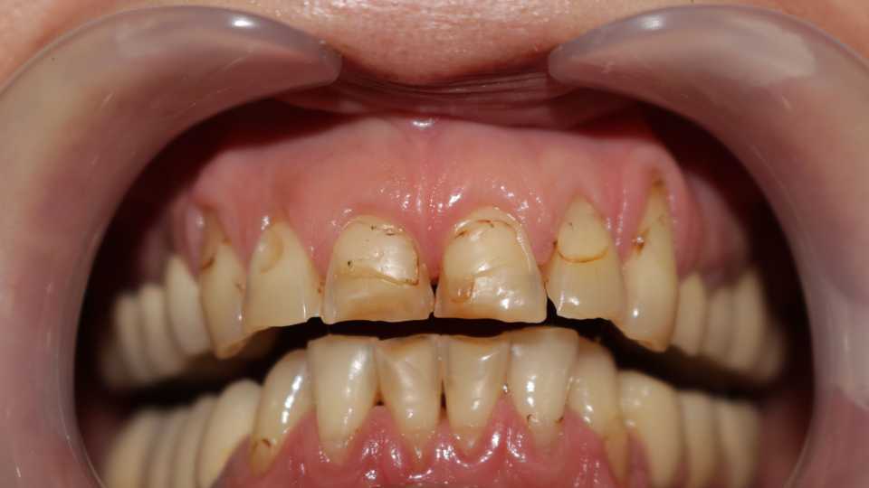 Coroane ceramice pe suport de zirconiu 1
