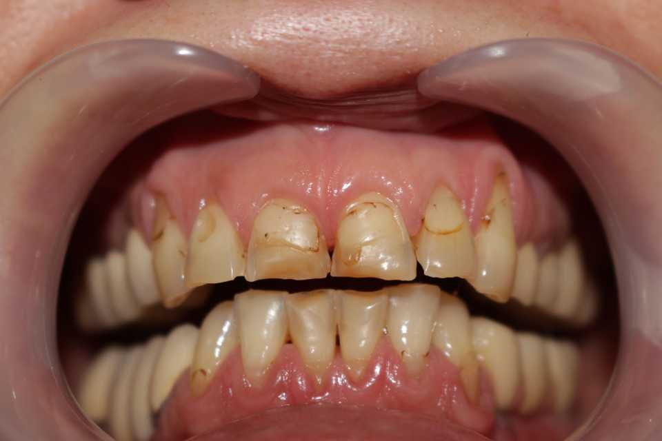 Coroane ceramice pe suport de zirconiu 1