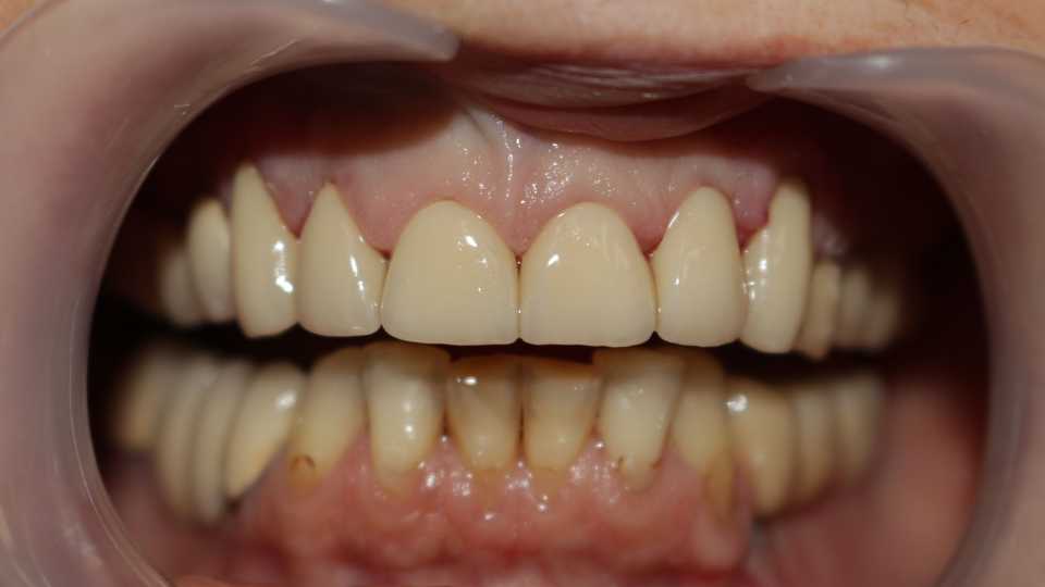 Coroane ceramice pe suport de zirconiu 2