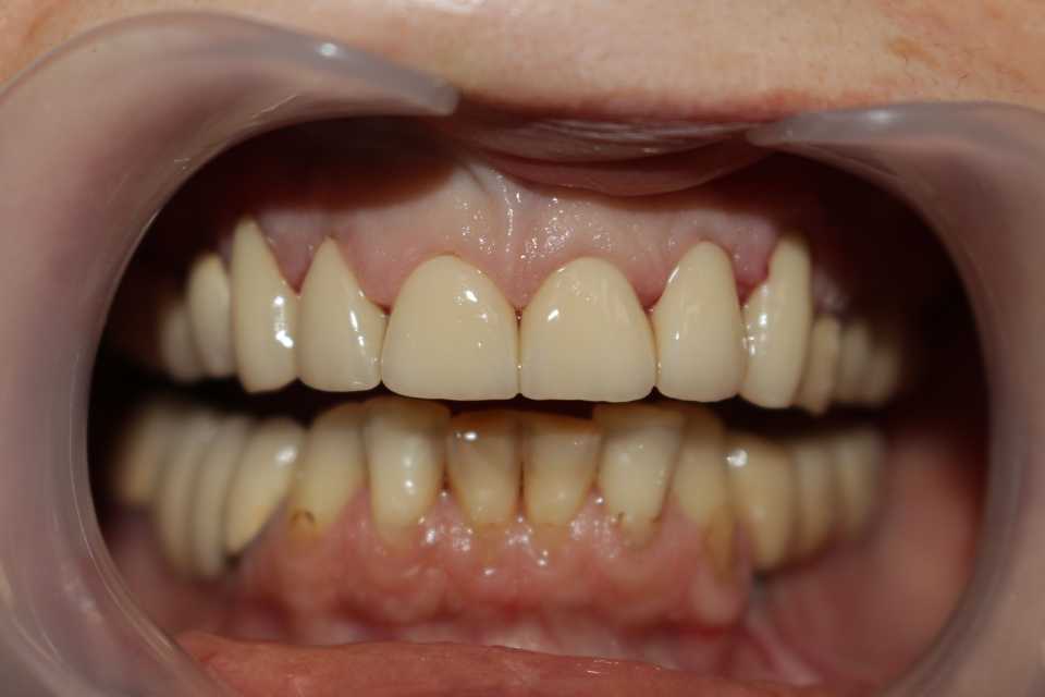 Coroane ceramice pe suport de zirconiu 2