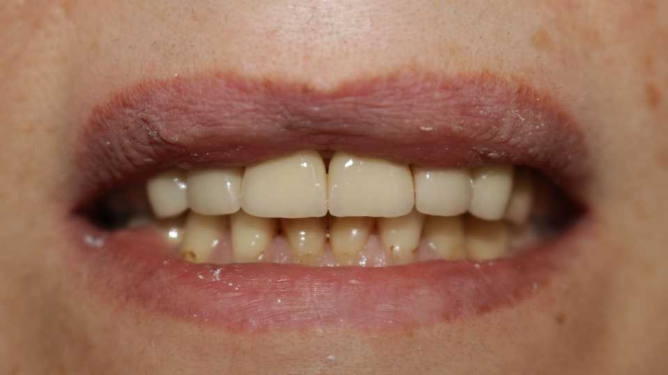 Coroane ceramice pe suport de zirconiu 3