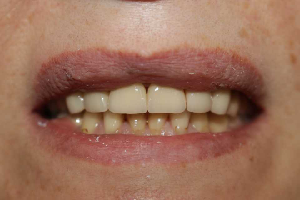 Coroane ceramice pe suport de zirconiu 3