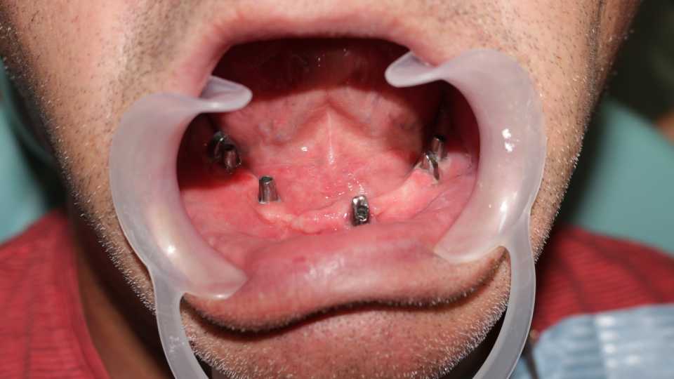 Cazul 44 - Implanturi dentare și proteză metalo-ceramică - 3