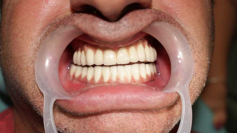 Cazul 44 - Implanturi dentare și proteză metalo-ceramică - 1