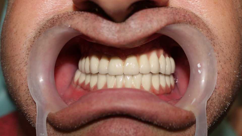 Cazul 44 - Implanturi dentare și proteză metalo-ceramică - 4