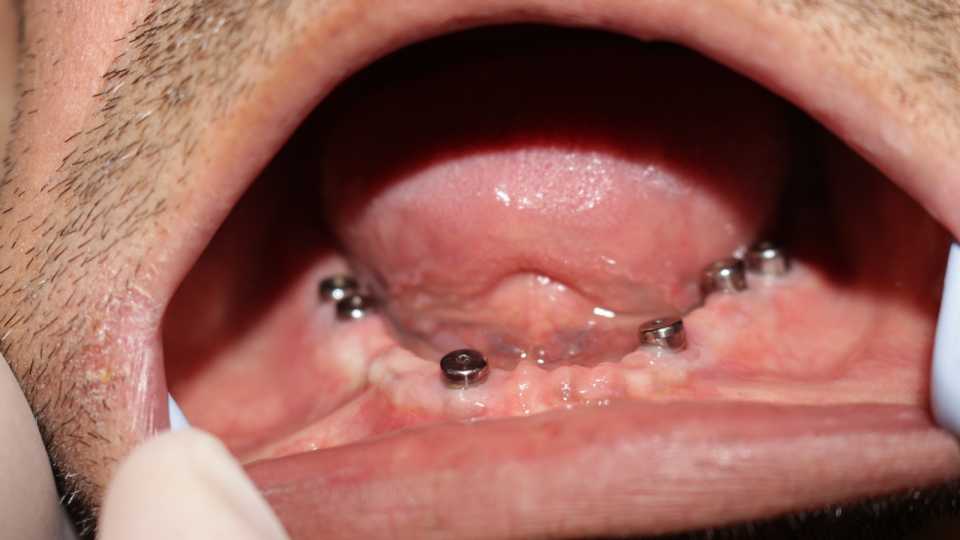 Lucrare protetică fixă pe 6 implanturi - 1