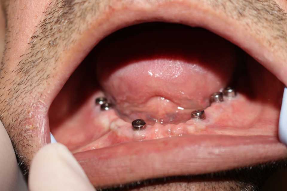 Lucrare protetică fixă pe 6 implanturi - 1