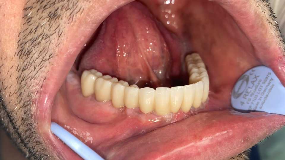 Lucrare protetică fixă pe 6 implanturi - 2