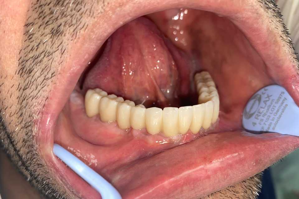 Lucrare protetică fixă pe 6 implanturi - 2