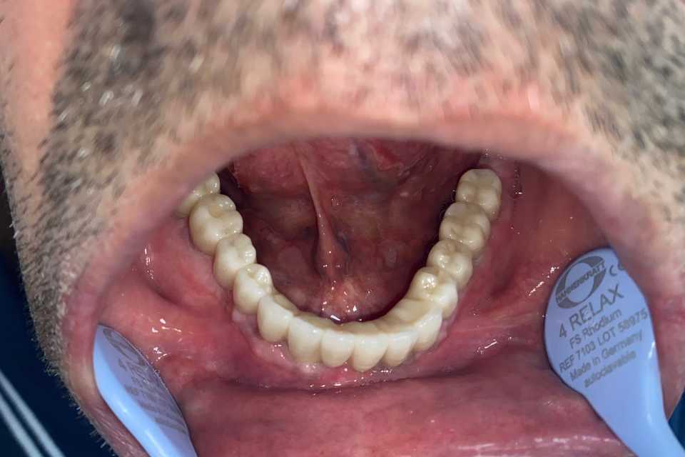 Lucrare protetică fixă pe 6 implanturi - 4