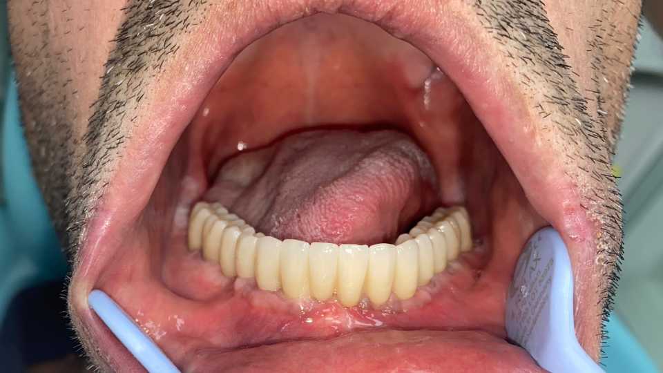 Lucrare protetică fixă pe 6 implanturi - 5