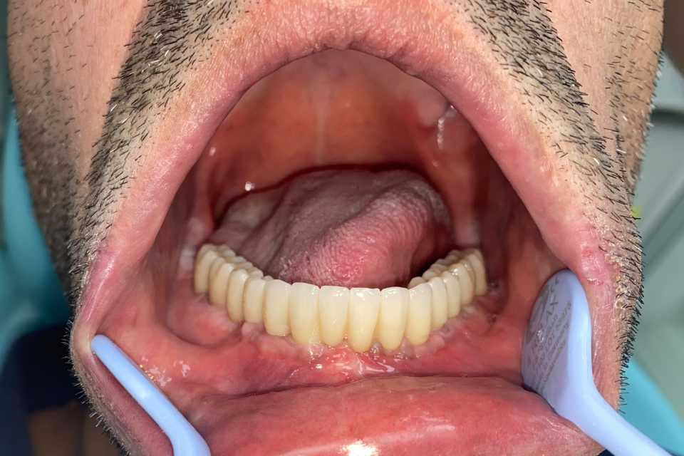 Lucrare protetică fixă pe 6 implanturi - 5
