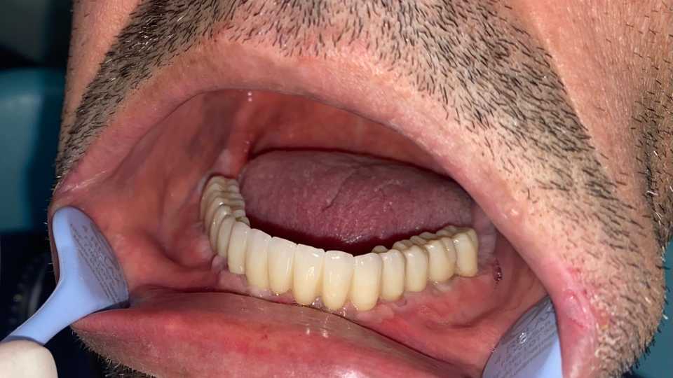 Lucrare protetică fixă pe 6 implanturi - 6