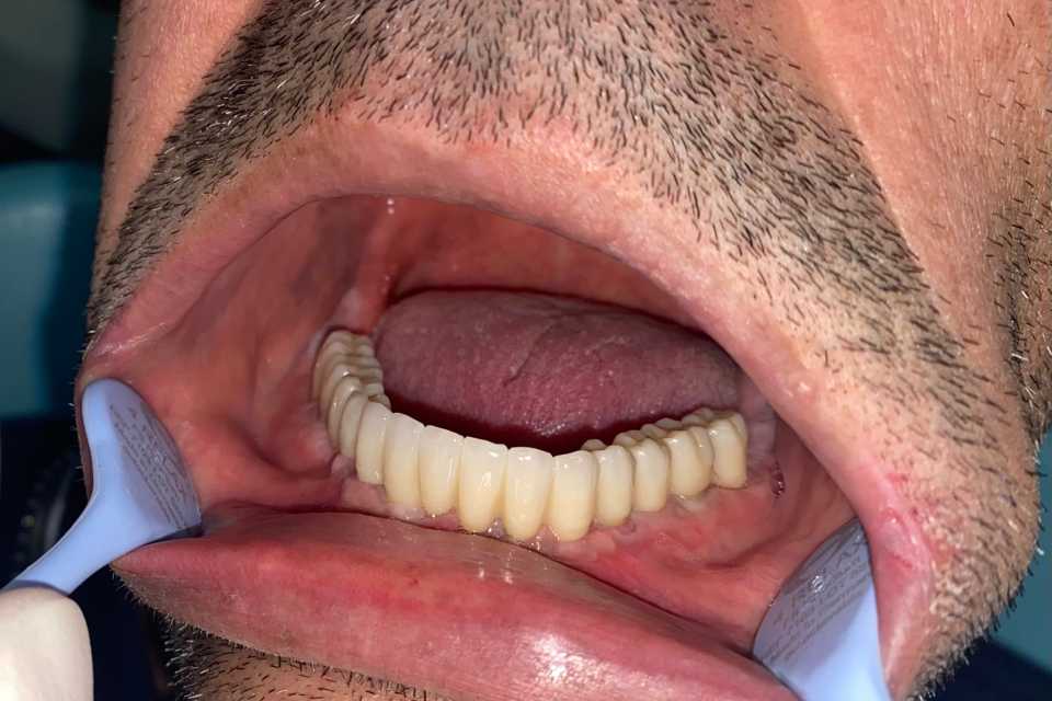 Lucrare protetică fixă pe 6 implanturi - 6