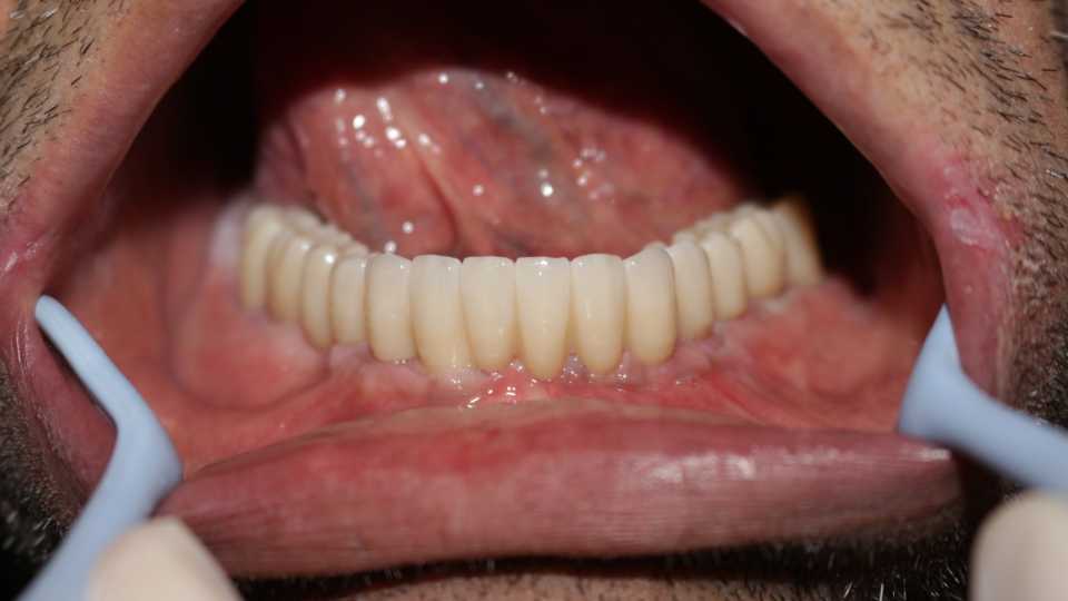 Lucrare protetică fixă pe 6 implanturi - 7