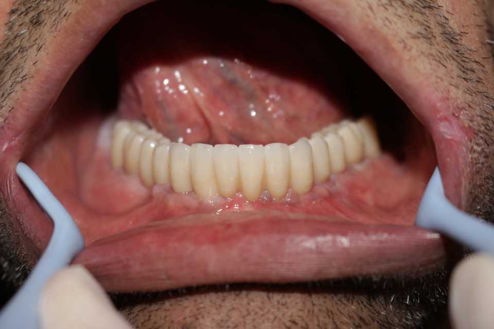 Lucrare protetică fixă pe 6 implanturi - 7