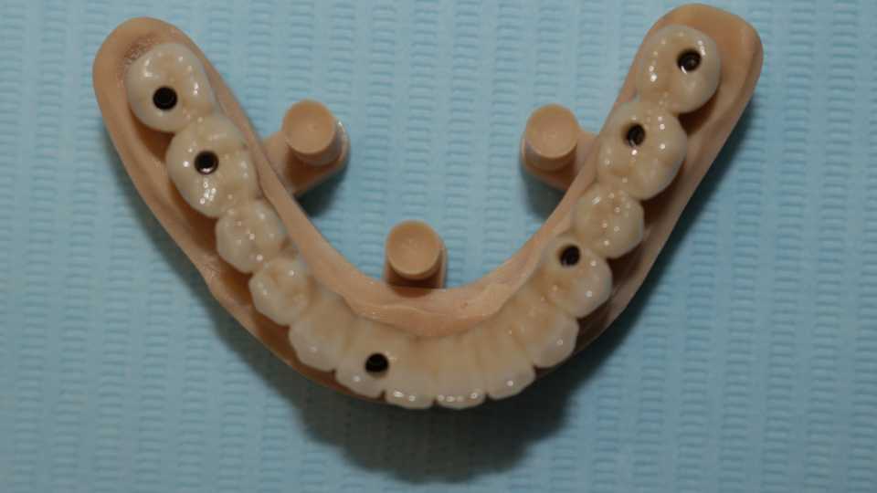 Lucrare protetică fixă pe 6 implanturi - 8