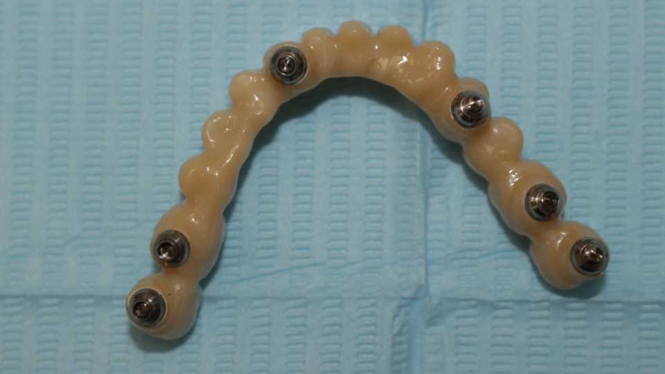 Lucrare protetică fixă pe 6 implanturi - 10