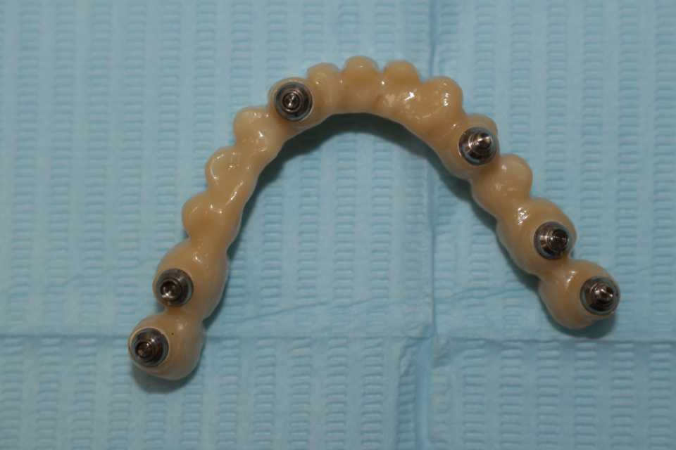 Lucrare protetică fixă pe 6 implanturi - 10