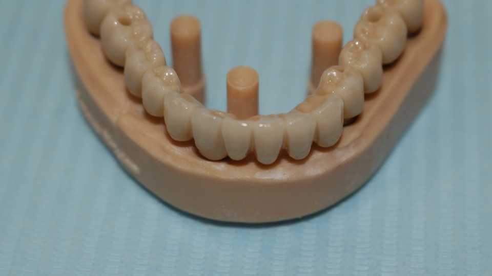 Lucrare protetică fixă pe 6 implanturi - 11