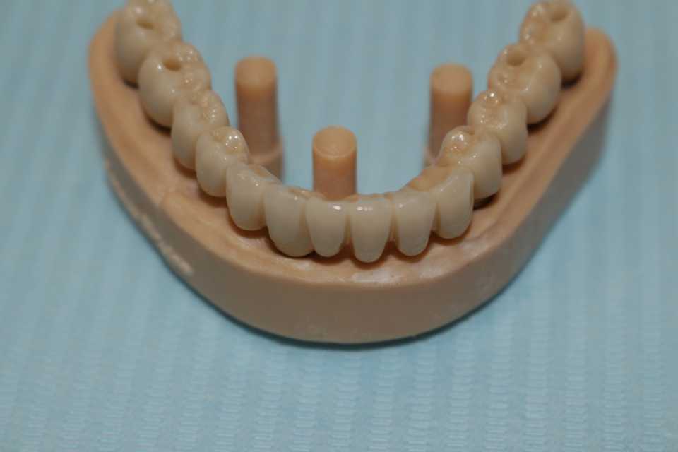 Lucrare protetică fixă pe 6 implanturi - 11