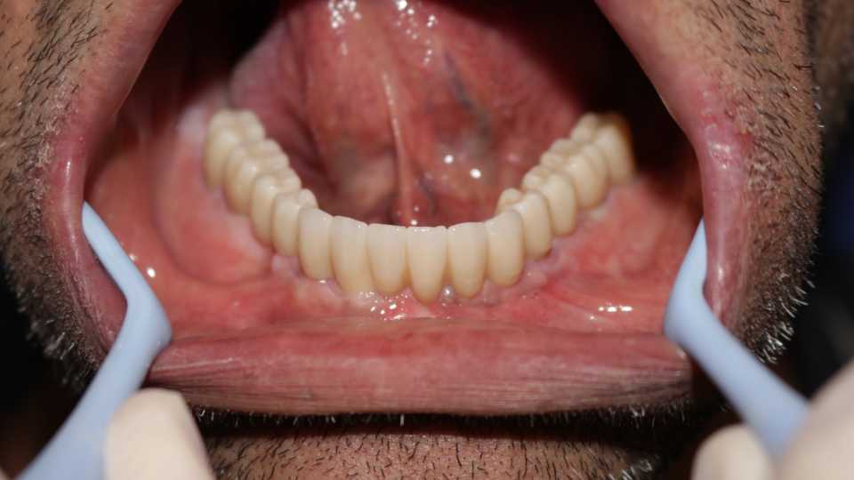 Lucrare protetică fixă pe 6 implanturi - 12