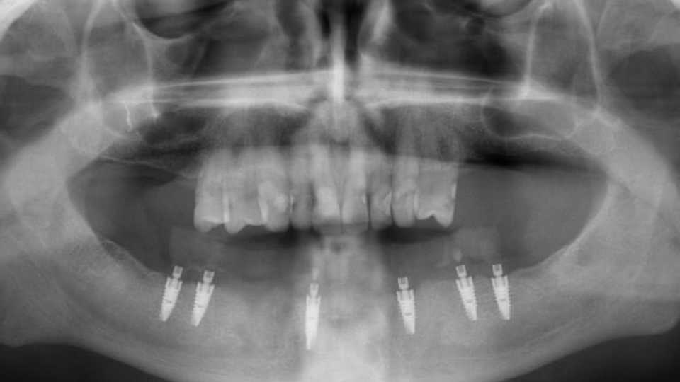 Lucrare protetică fixă pe 6 implanturi - 13