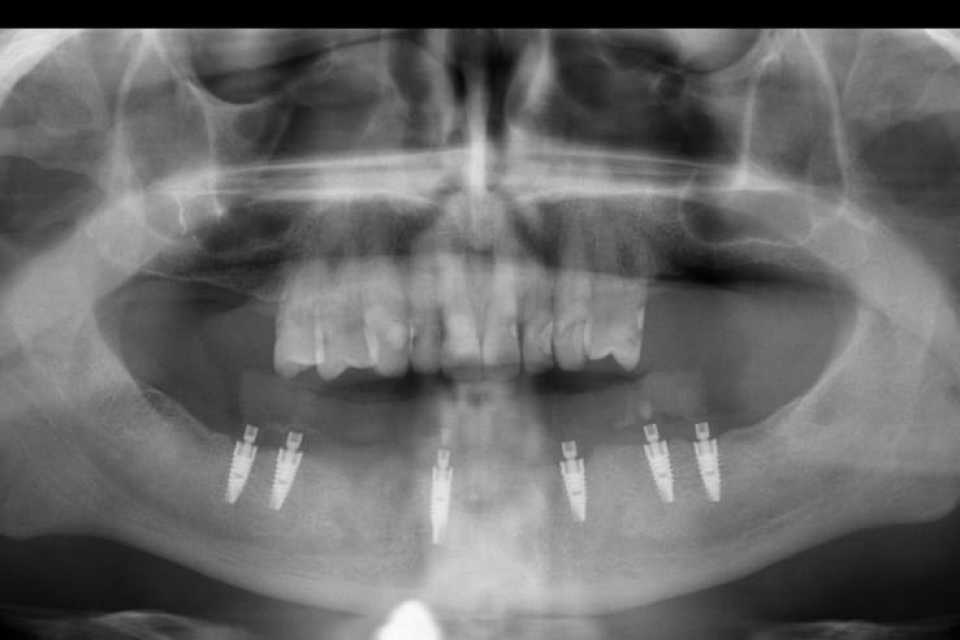 Lucrare protetică fixă pe 6 implanturi - 13