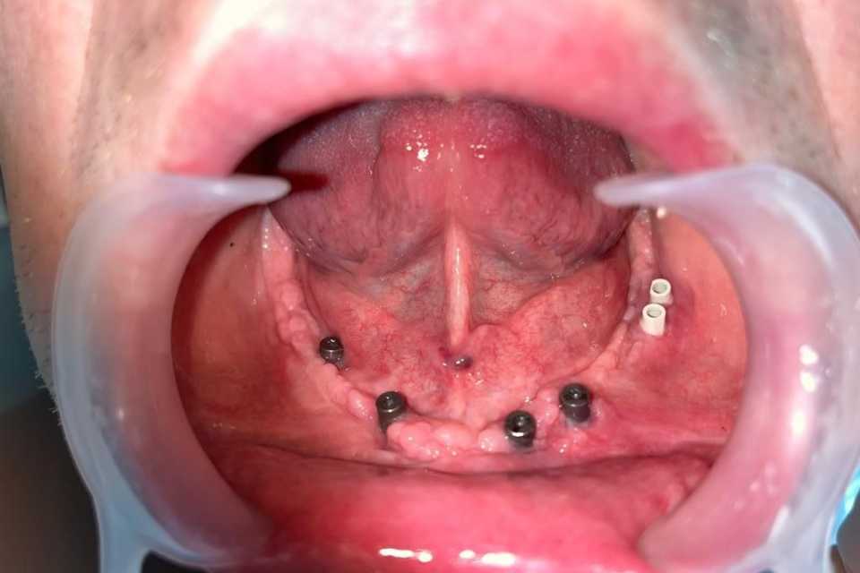 Lucrare fixă înșurubabilă pe implanturi Straumann - 1