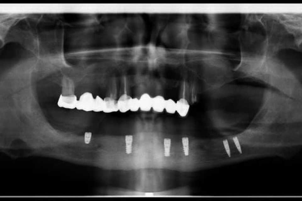 Lucrare fixă înșurubabilă pe implanturi Straumann - 8