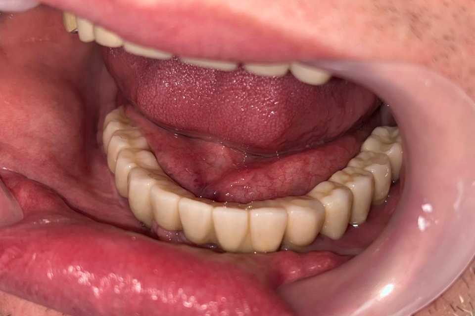 Lucrare fixă înșurubabilă pe implanturi Straumann - 7