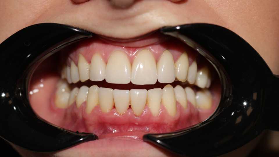 Fațete dentare E-max - 1