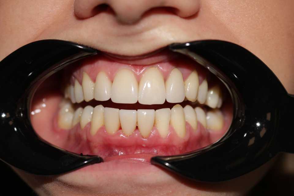 Fațete dentare E-max - 1