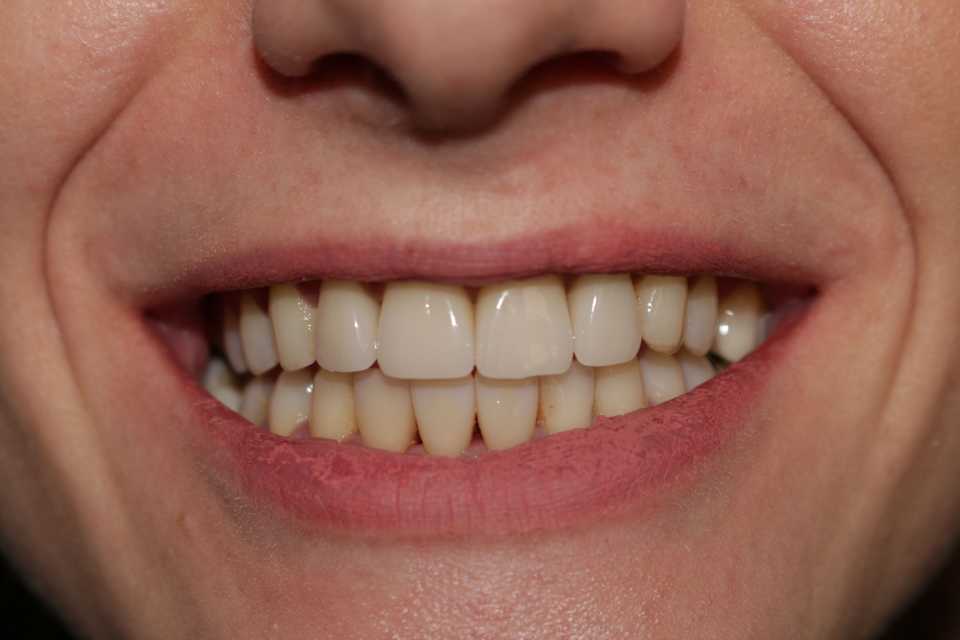 Fațete dentare E-max - 6