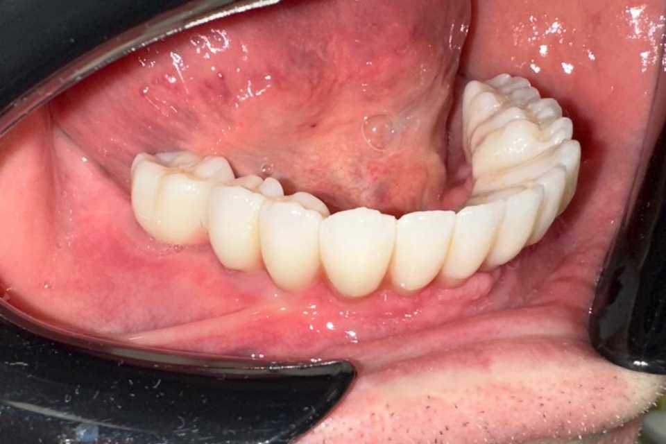 Cazul 55 - Lucrari protetice fixe pe implanturi Paltop 2