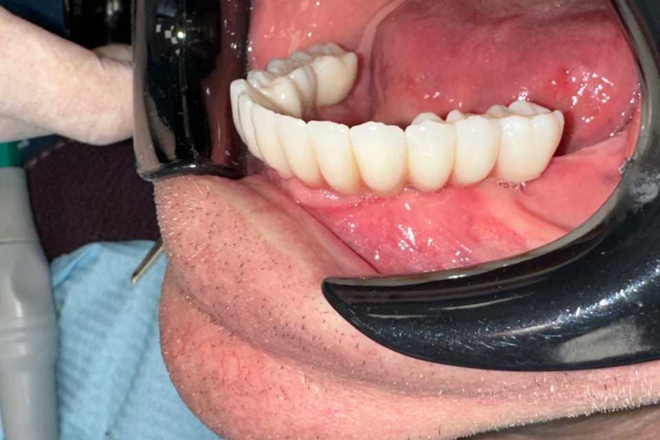 Cazul 55 - Lucrari protetice fixe pe implanturi Paltop 3