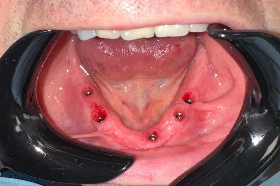 Cazul 55 - Lucrari protetice fixe pe implanturi Paltop 5