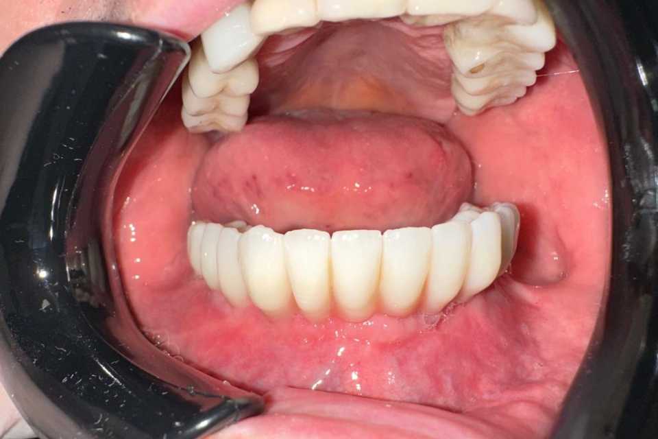 Cazul 55 - Lucrari protetice fixe pe implanturi Paltop 6