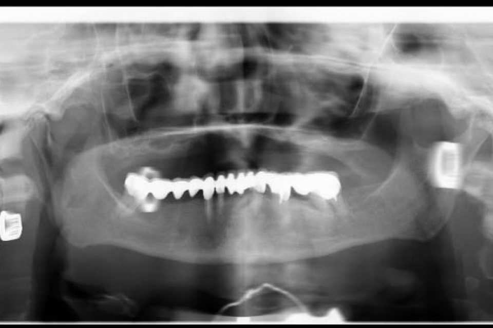 Lucrare dentară protetică fixă din ceramica pe zirconiu 2