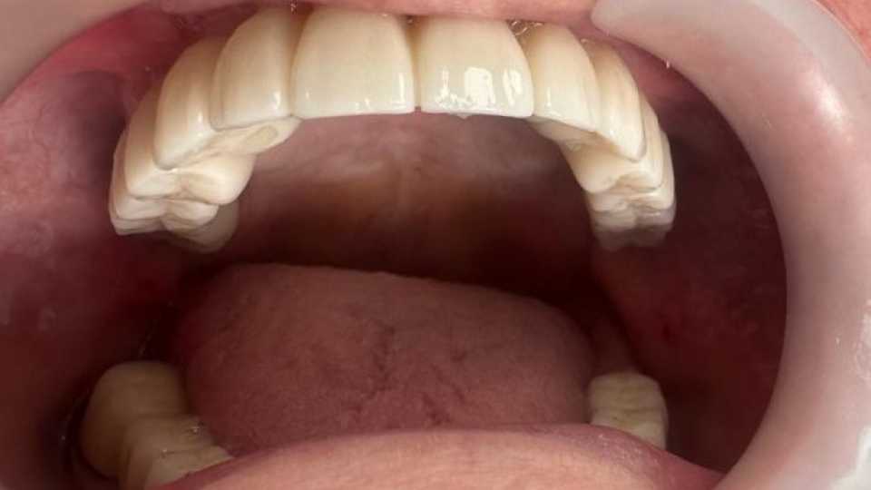 Lucrare dentară protetică fixă din ceramica pe zirconiu 5