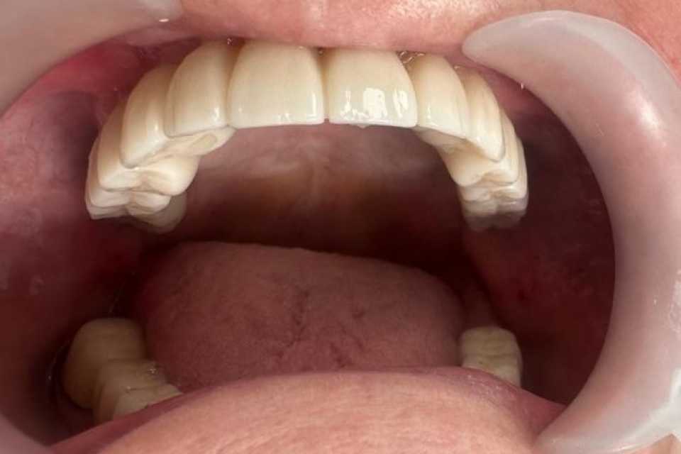 Lucrare dentară protetică fixă din ceramica pe zirconiu 5