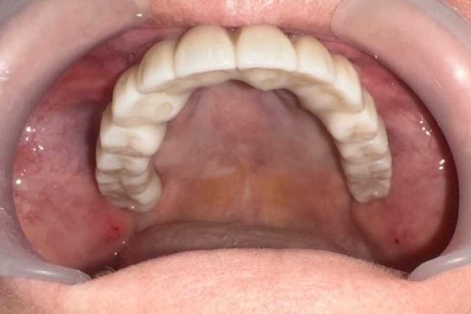 Lucrare dentară protetică fixă din ceramica pe zirconiu 6