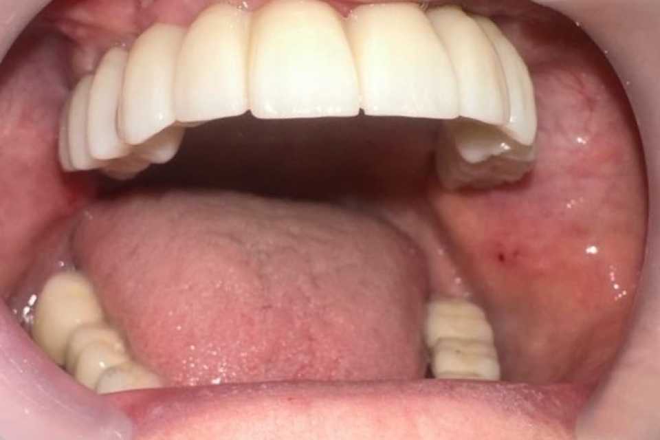 Lucrare dentară protetică fixă din ceramica pe zirconiu 7