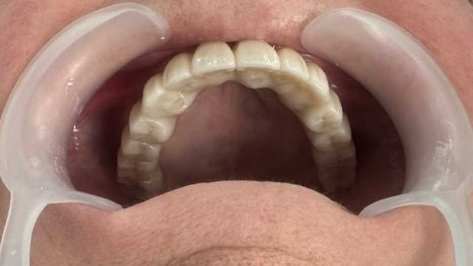 Lucrare dentară protetică fixă din ceramica pe zirconiu 9